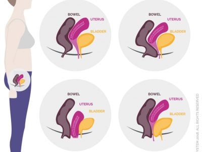 pelvic organ prolapse MUTU