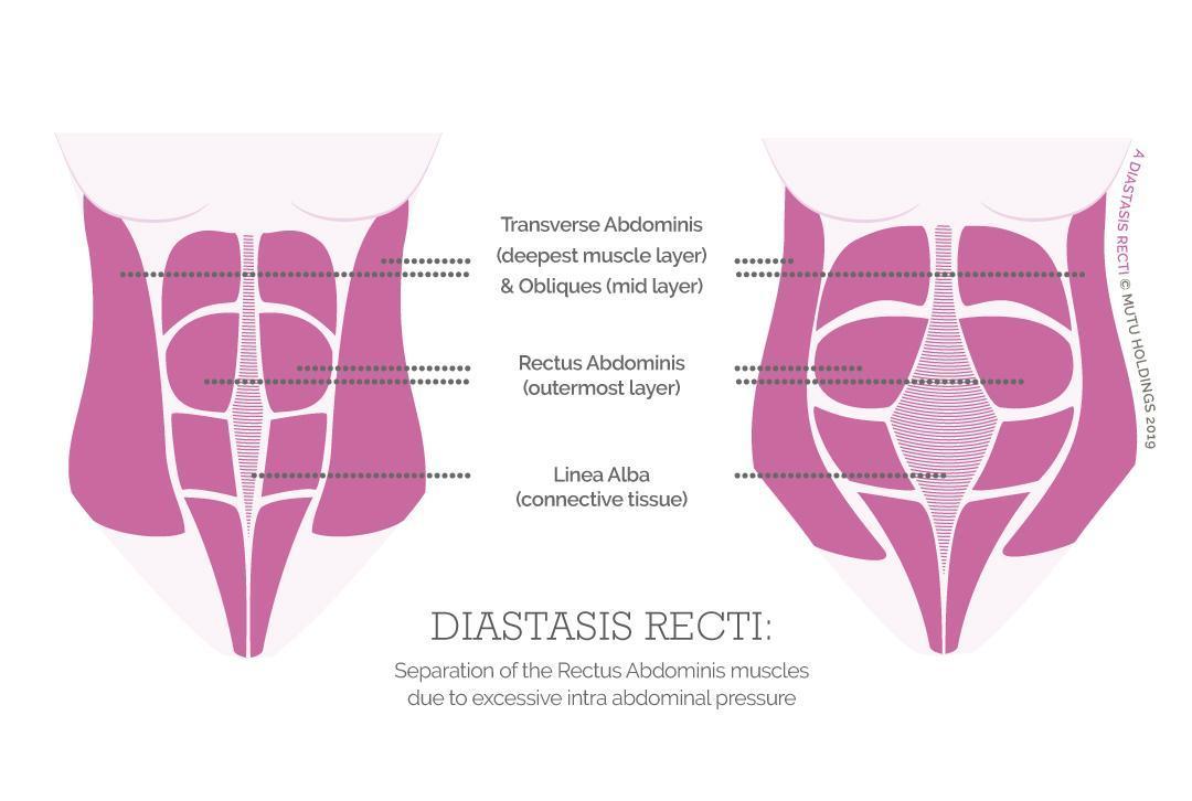 Diastasis Recti Abdominis  What actually happens to your abs?