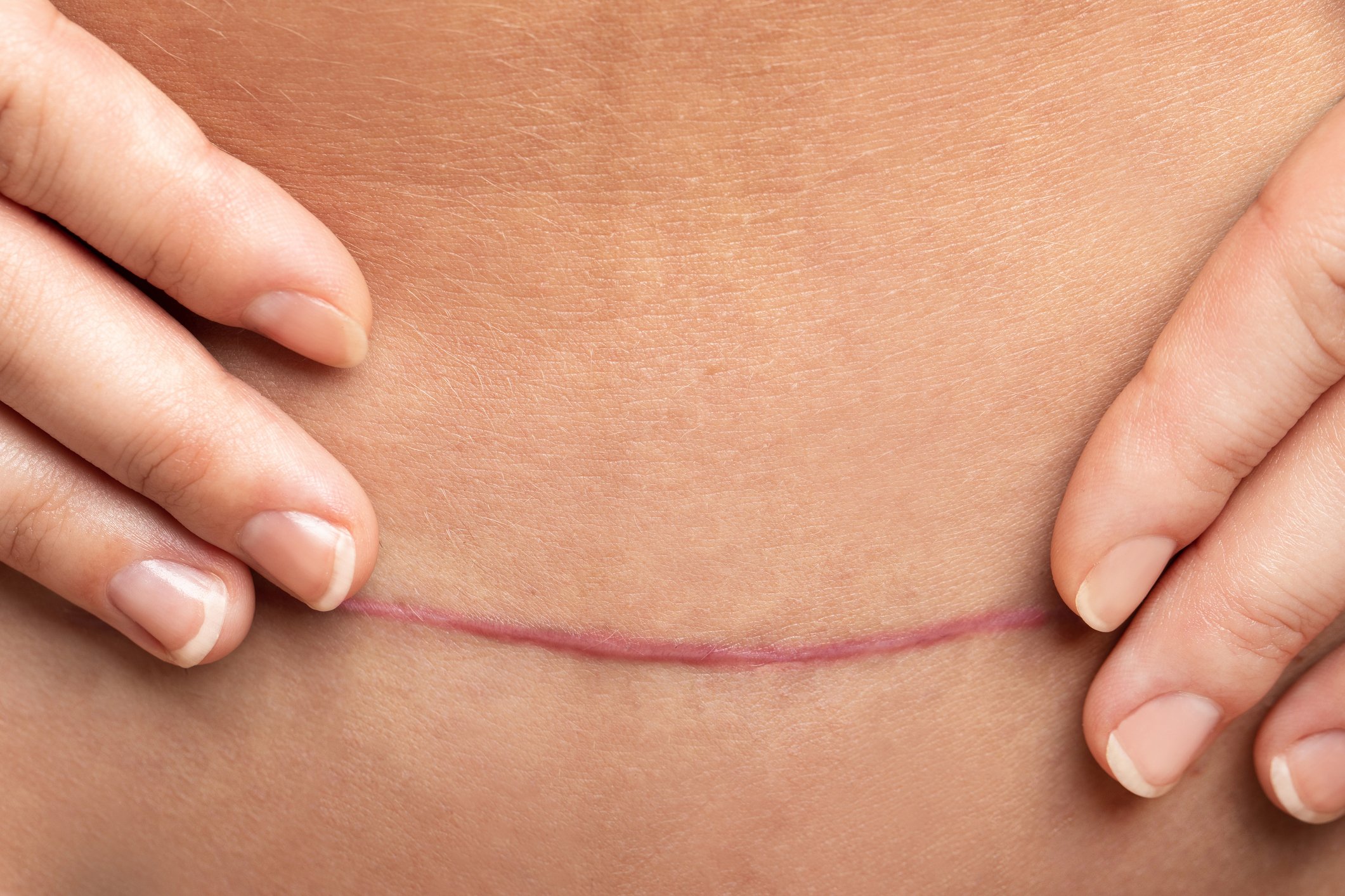 c section scar pain