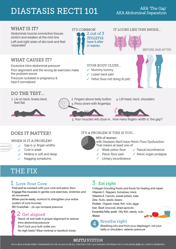 Diastasis Recti Infographic From Mutu