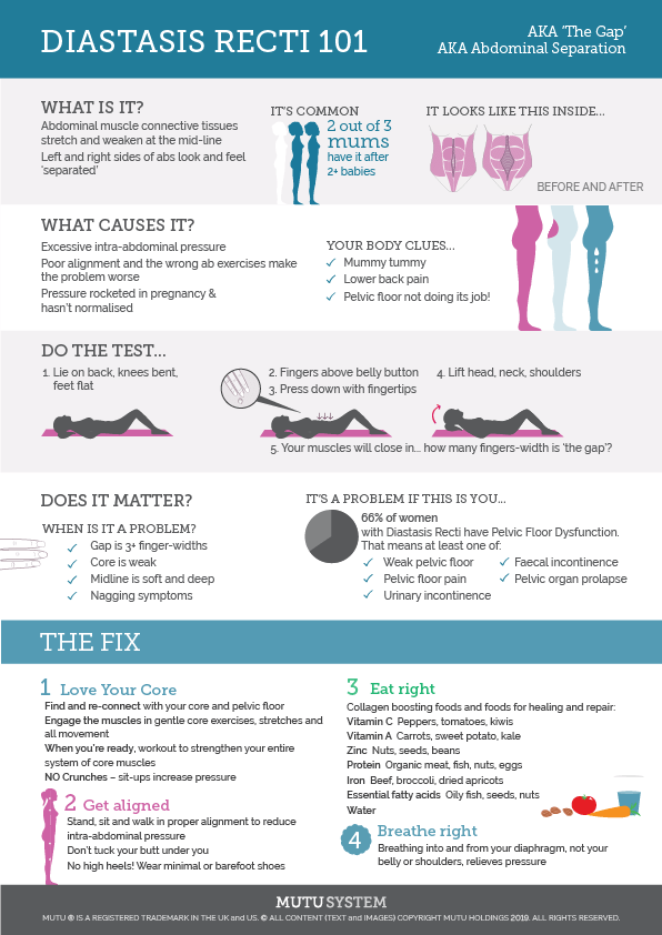 Diastasis recti Infographic from MUTU System to share