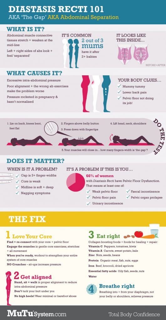 diastasis recti infographic with tips on how to fix yours