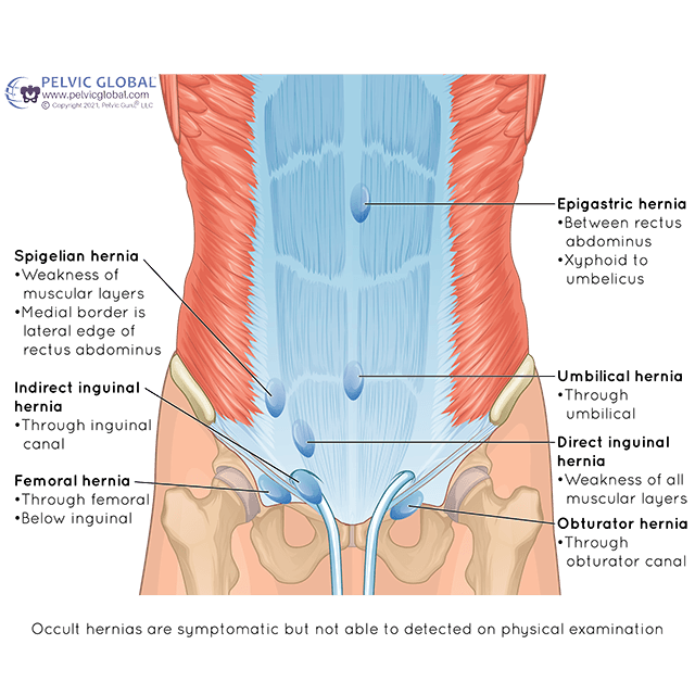 C-Section, Hernia, Appendicitis, Laparoscopy - Recovery Kit