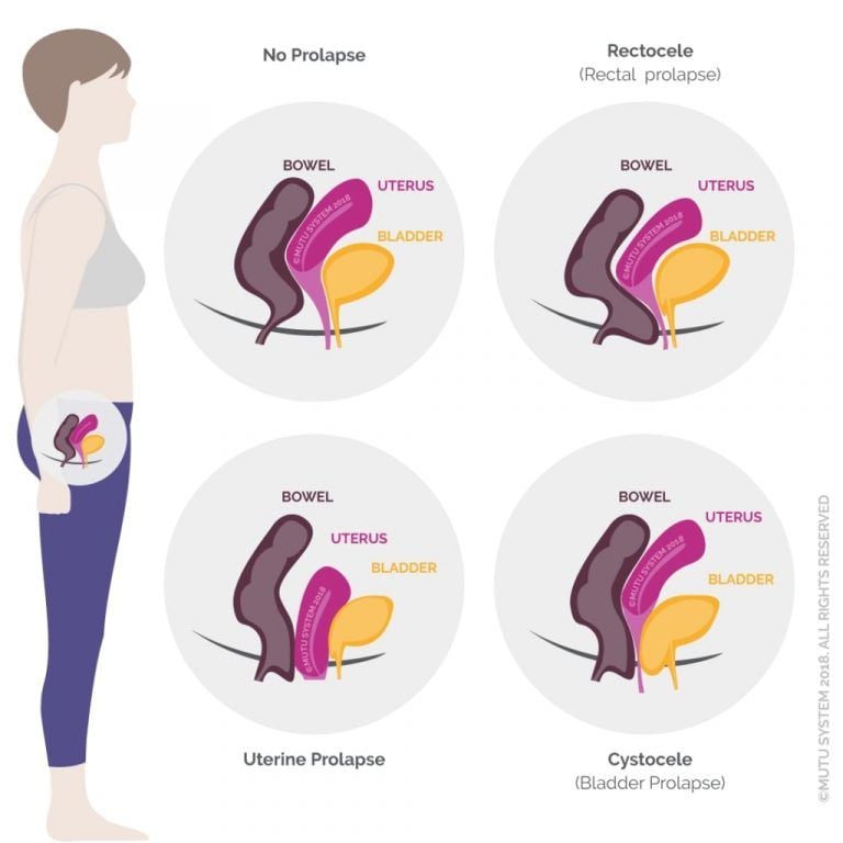 Safe Exercises For Pelvic Organ Prolapse 9593