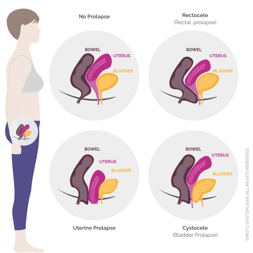 different types of pelvic floor prolapse compared