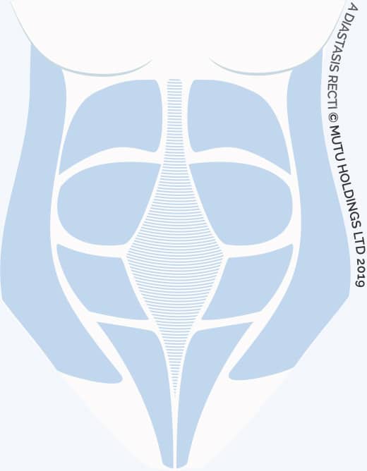 Can You Heal Diastasis Recti Years Later? Yes here's how!