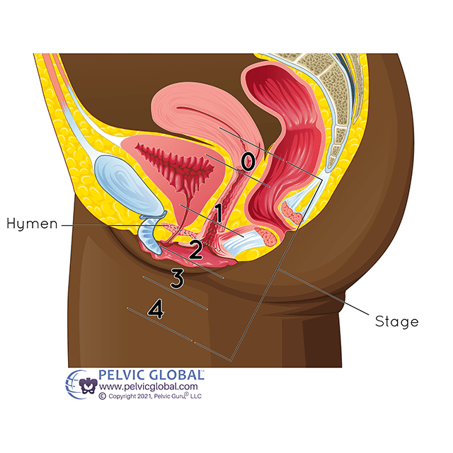 Prolapsed Bladder, Cystocele Repair Surgery