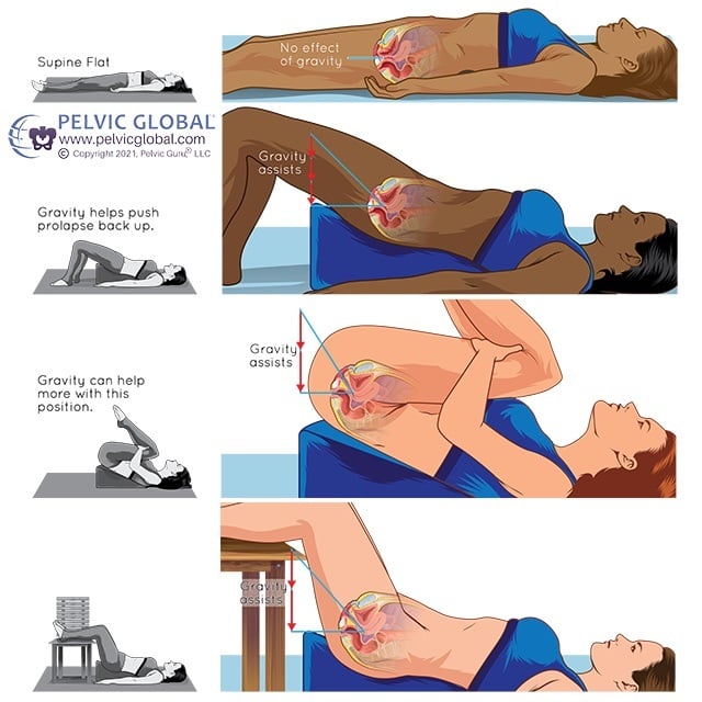 using a wedge to exercise with prolapse